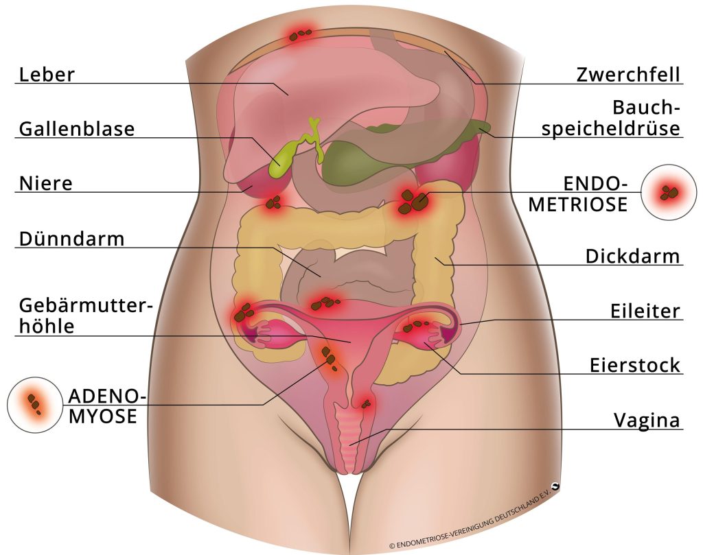 AnatomieEndo